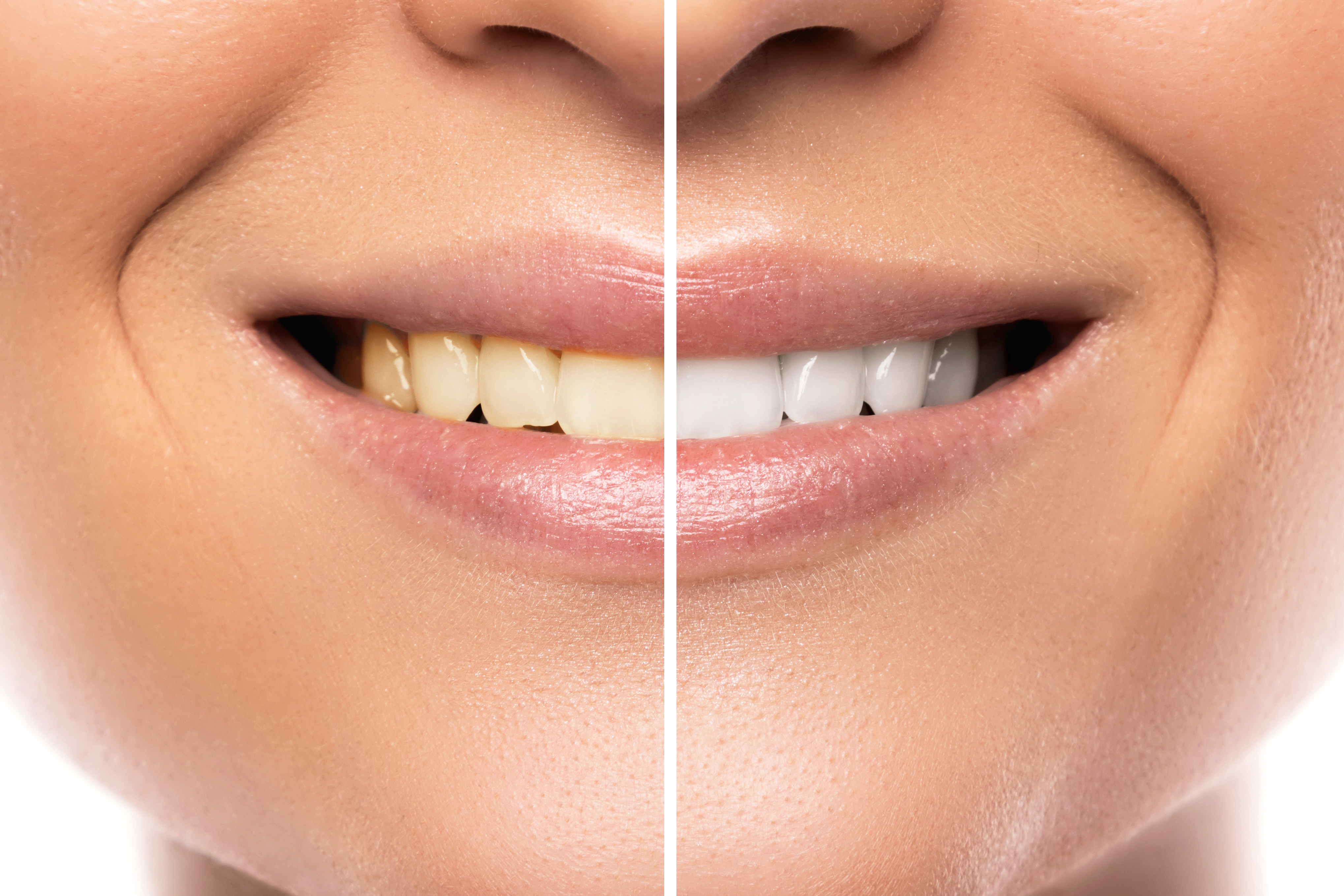 Do You Want A Brighter Smile Newhall Ca Newhall Dentist Asks
