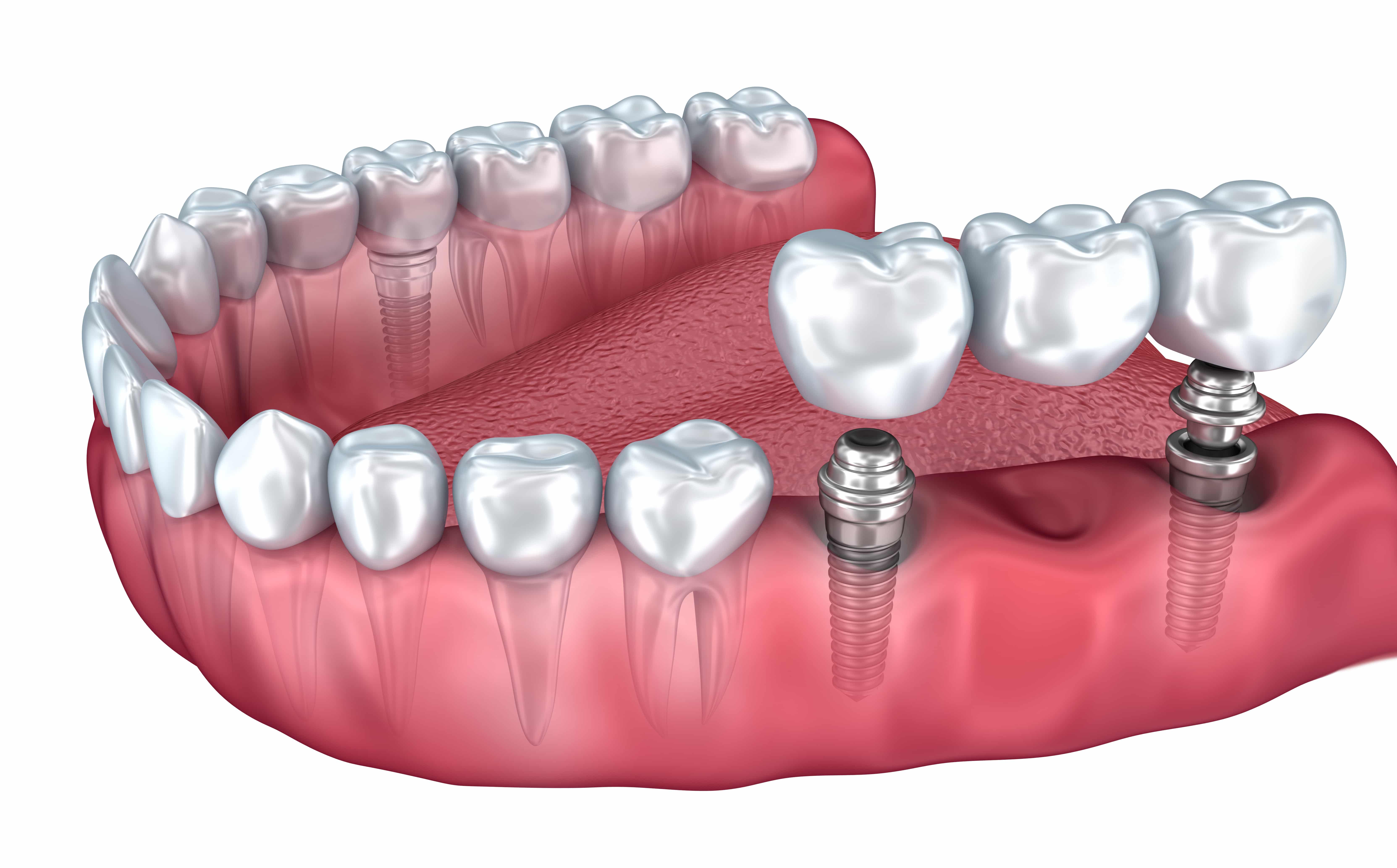 Протез на 2х имплантах. Мостовидный протез на имплантах 3 зуба. Несъёмный мостовидный протез челюсти. Мостовидный протез на 2 имплантах. Зубной мост мостовидный протез.
