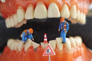 newhall dental bonding