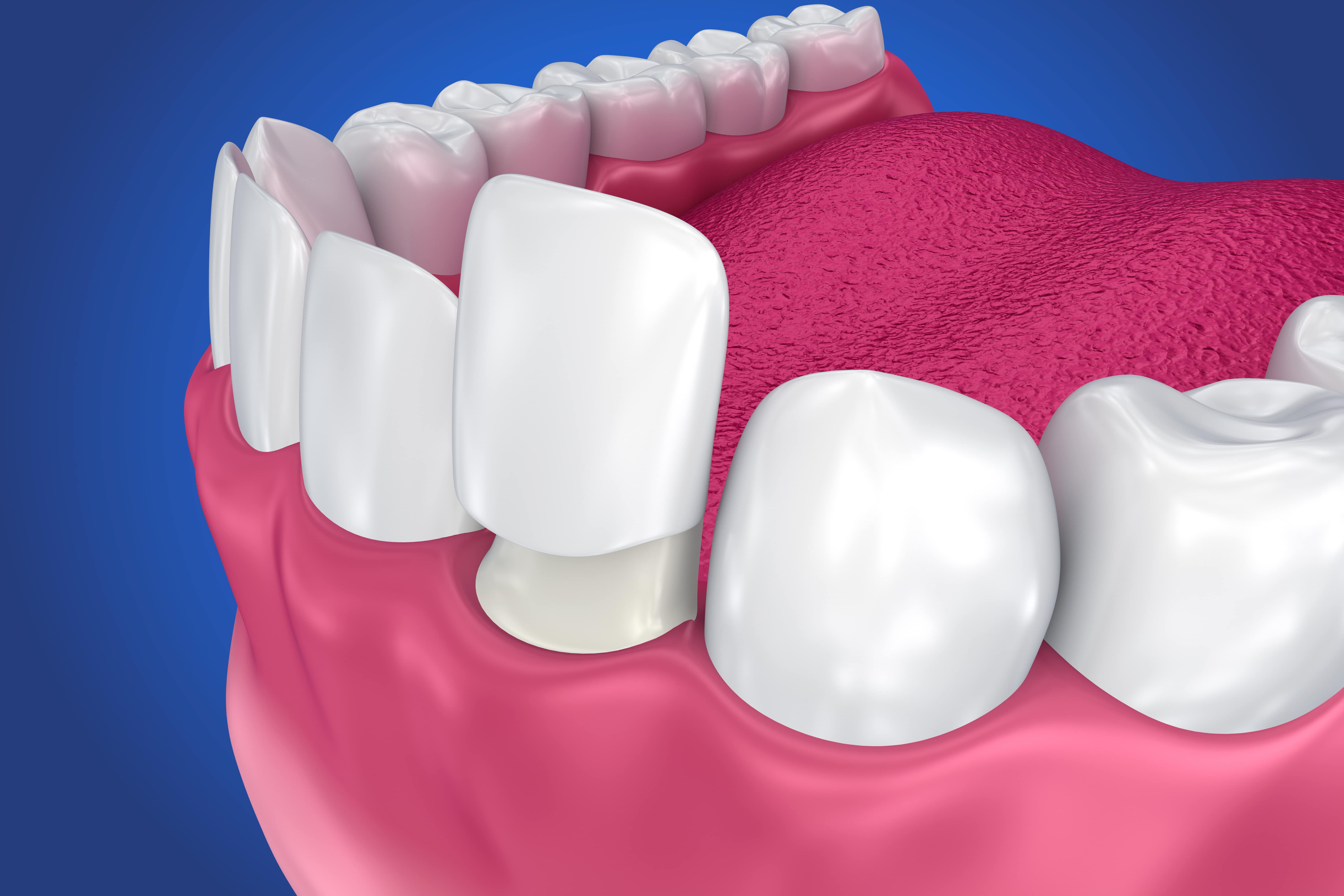 Микропротезы виниры вкладки стоматология