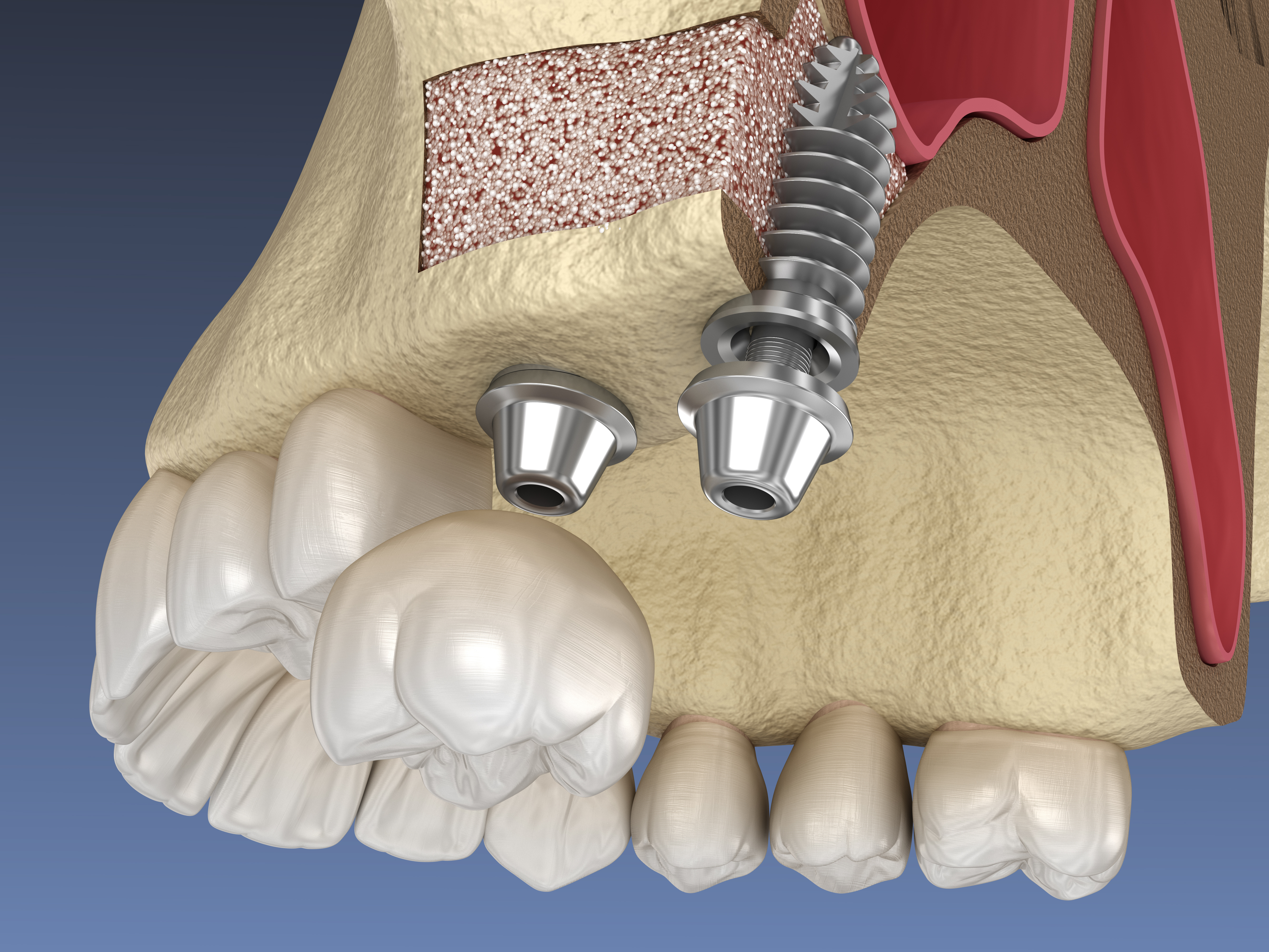 Восстановление костной ткани зубов. Синус-лифтинг (костная пластика, остеопластика). Имплантирование синус лифтинг. Синус-лифтинг открытый 10520. Синус лифтинг верхней челюсти.