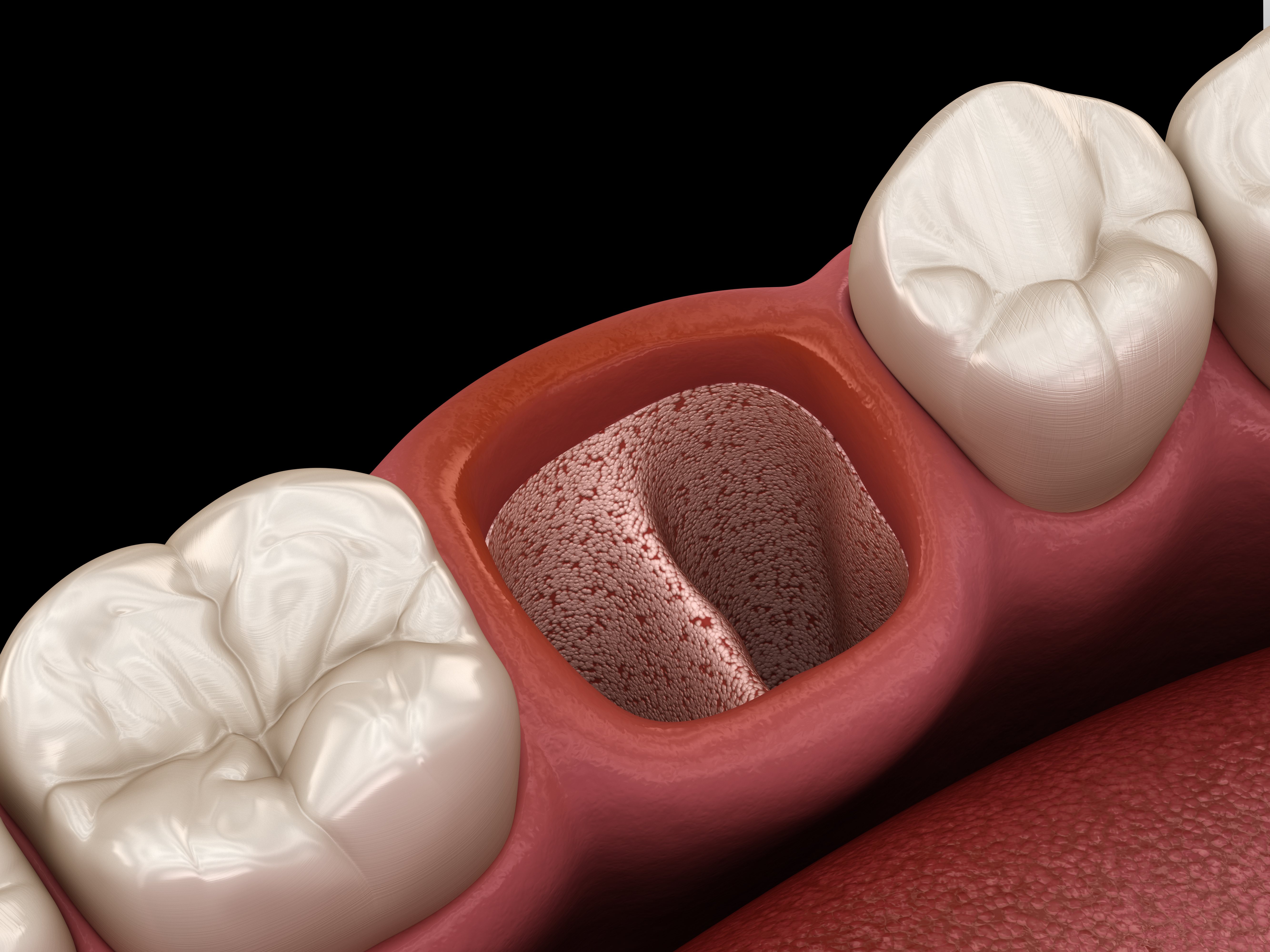 Tooth extraction. Альвеолит в стоматологии. Гипертрофический альвеолит. Альвеолит зубной лунки.