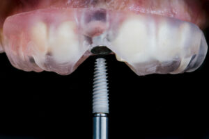 newhall grafting and implant placement