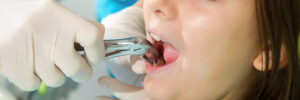 newhall tooth extraction