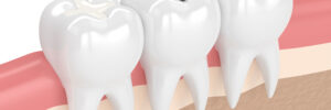 newhall dental fillings