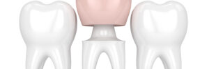 newhall porcelain crowns