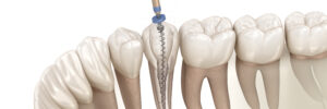 newhall root canal treatment