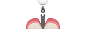 newhall guided implant placement