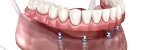 newhall implant dentures