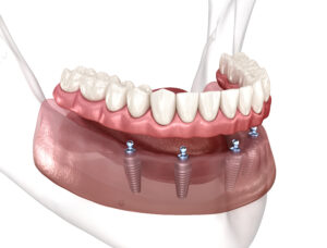 newhall implant dentures
