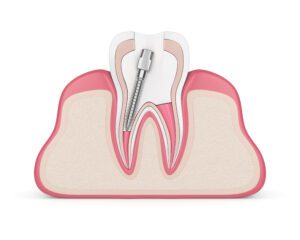 newhall root canal therapy