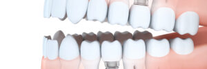 newhall dental implants