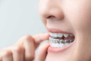 newhall invisalign