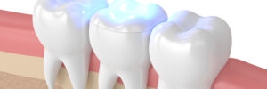 newhall dental fillings